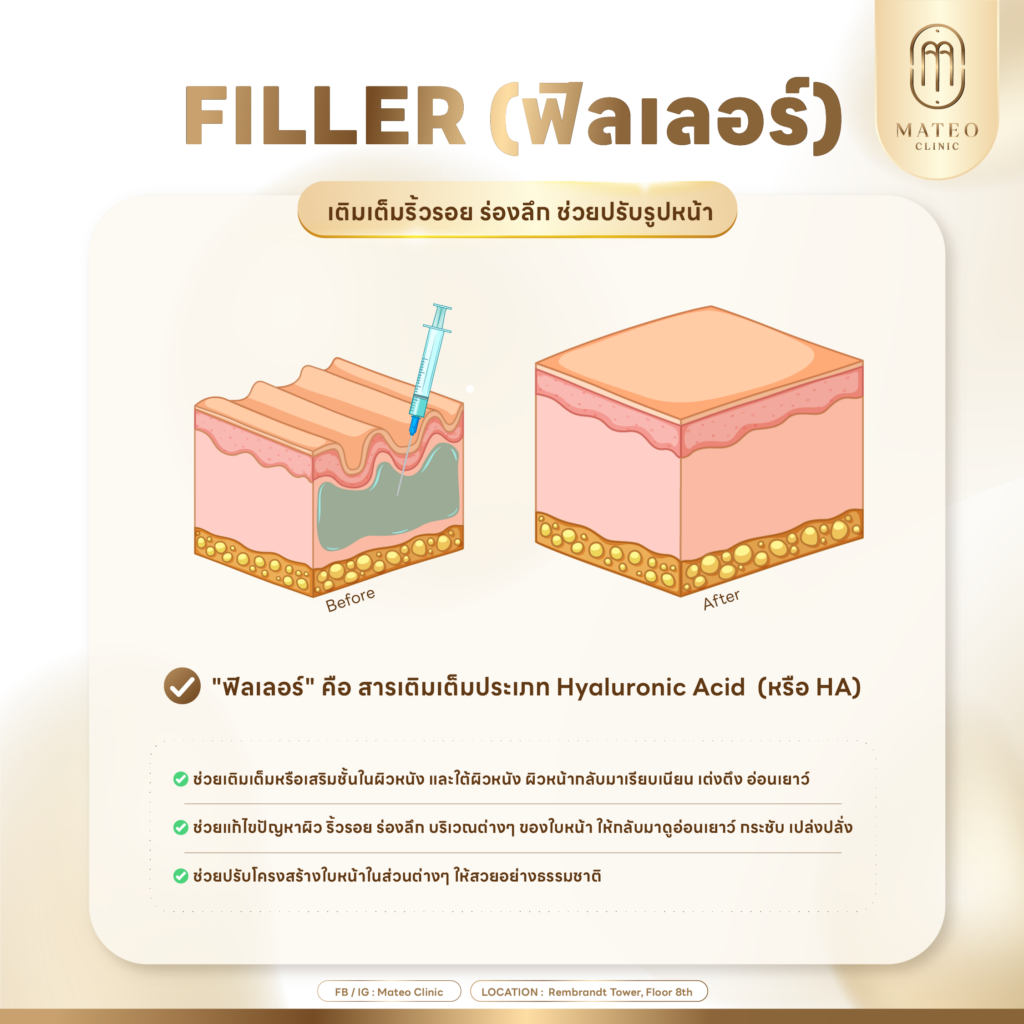 ฟิลเลอร์คืออะไร